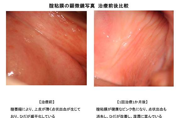 膣粘膜の顕微鏡写真 治療前後比較